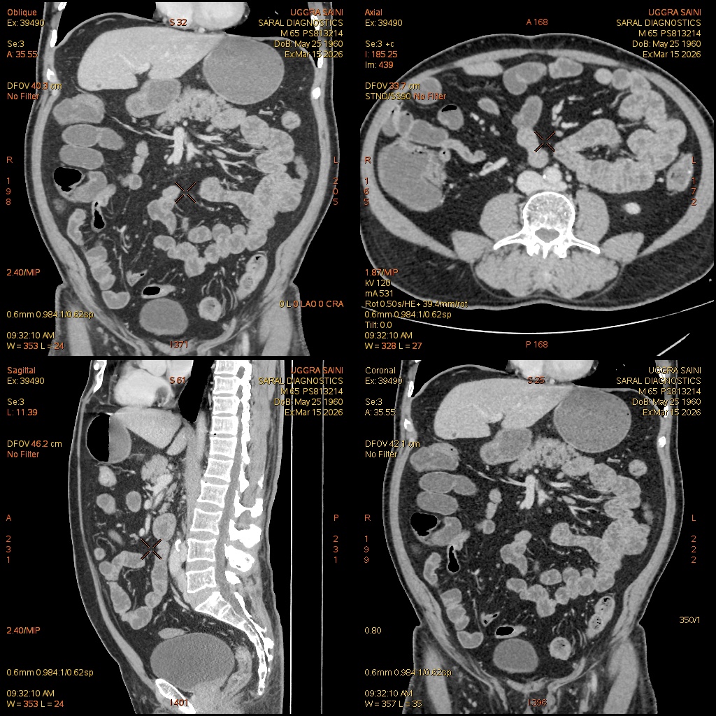 Enterography with IV contrast