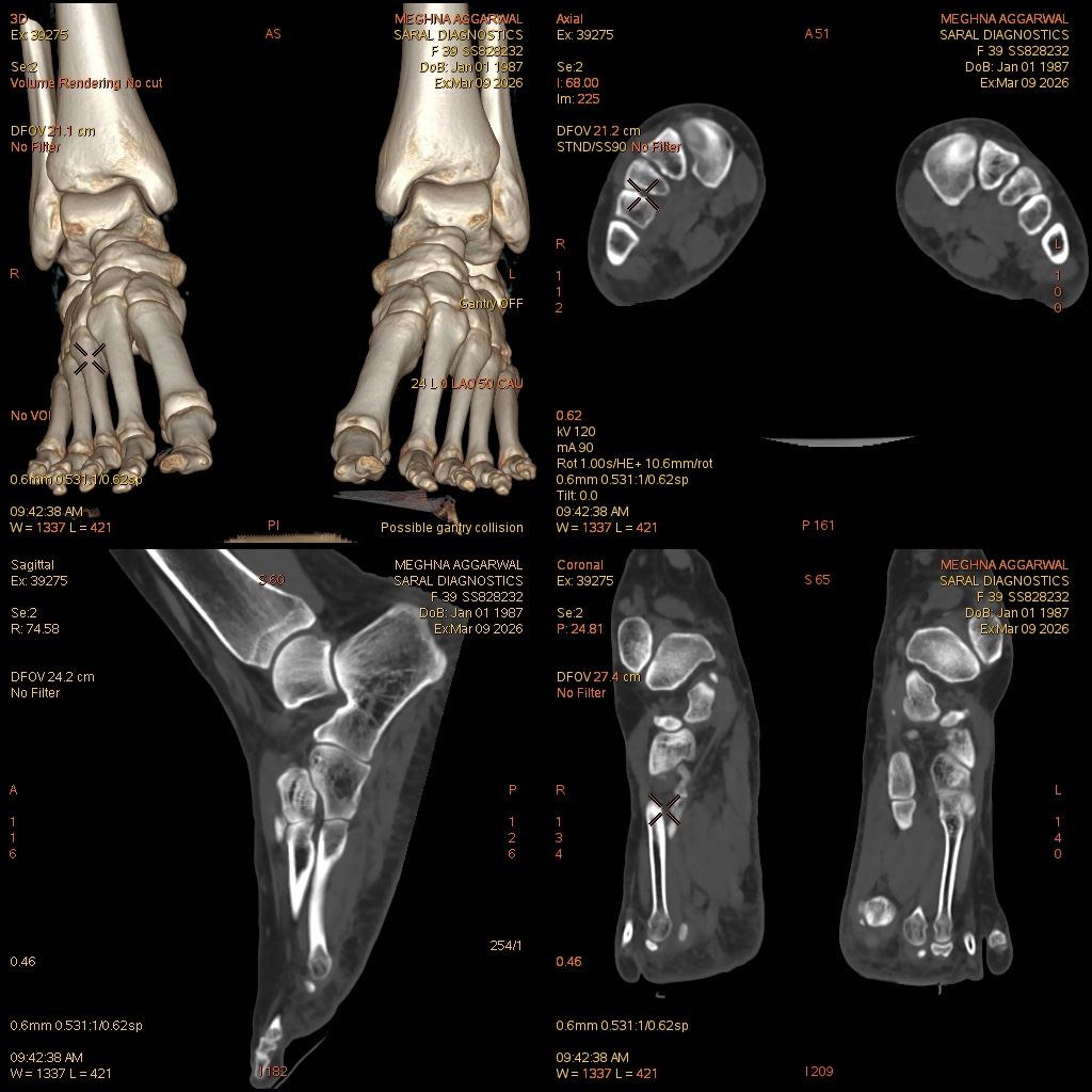 Left Foot (Scan charges only)