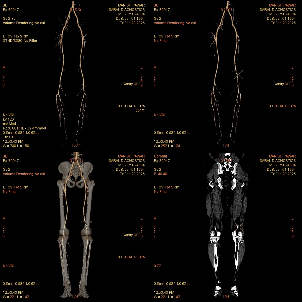 Lower Limb (scan charges only)