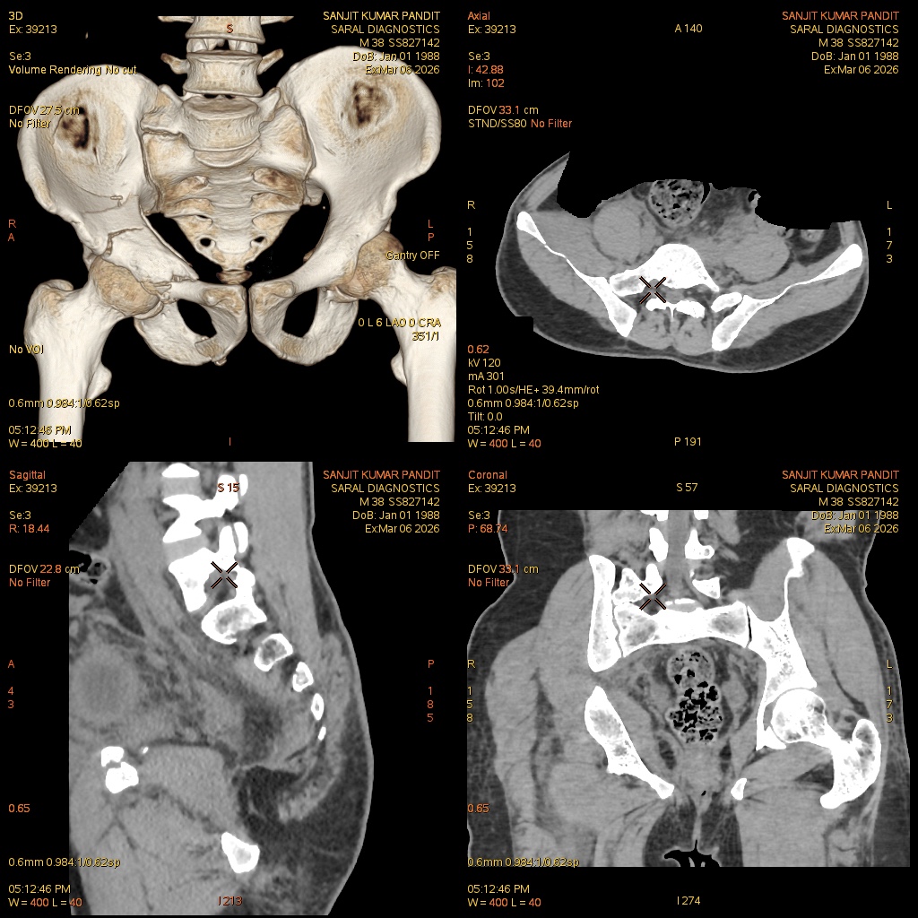 Pelvis (Bony) With Both Hip Joint (Scan Charges Only)