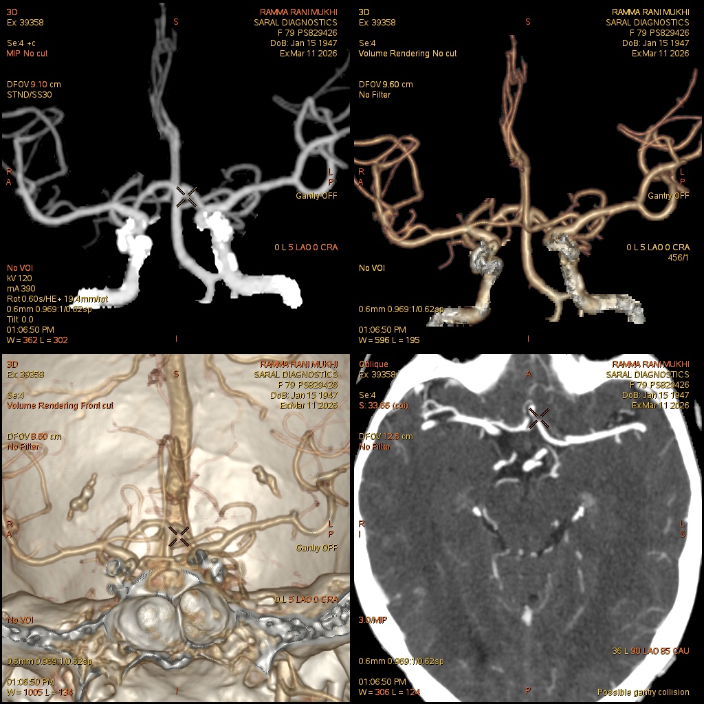Angiography Brain (Scan charges only)