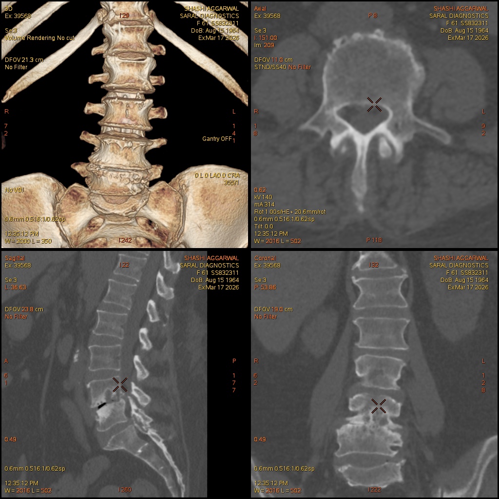 LS Spine (Scan charges only)