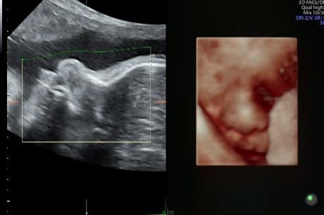 3D Gynae (Pelvis TVS)