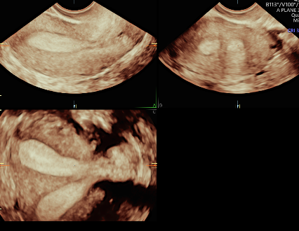 3D / 4D Gynae with Colour Doppler