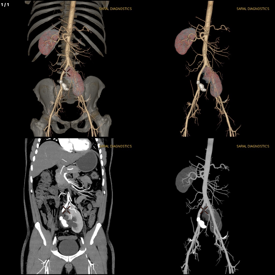 Abdomen Whole With Abdominal Angiography (Scan Charges Only)