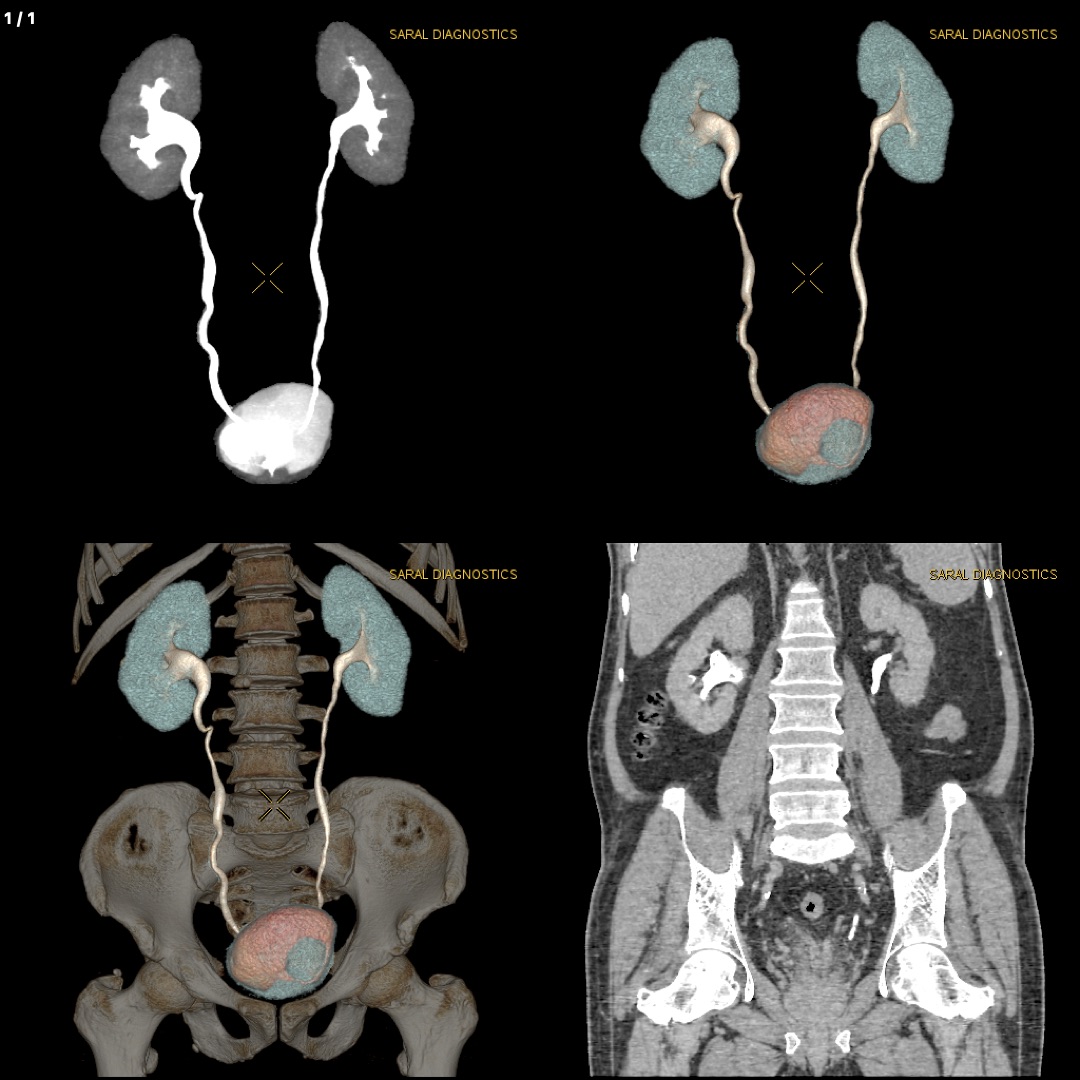Abdomen Whole  With Urography (Scan Charges Only)
