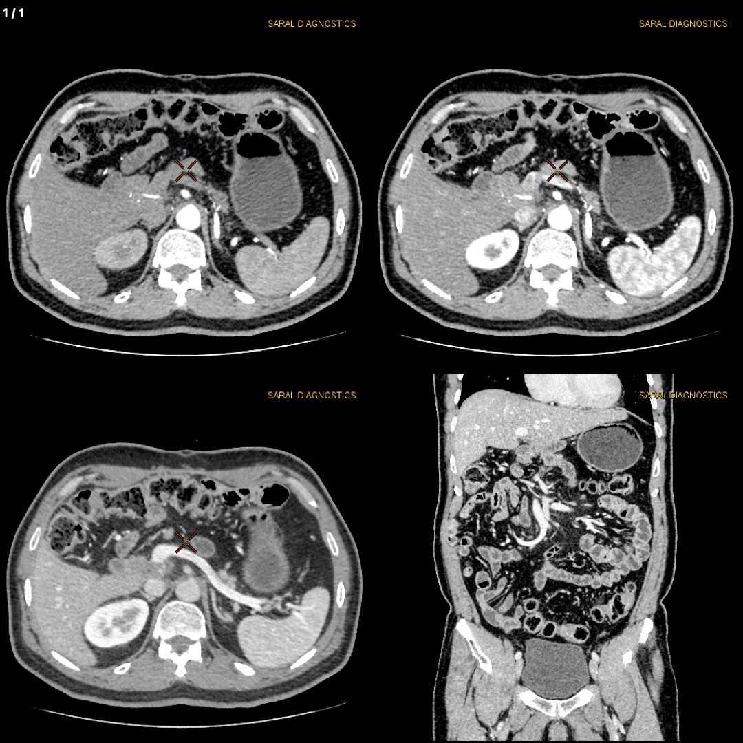Abdomen Whole With Pancreatic Protocol with Contrast