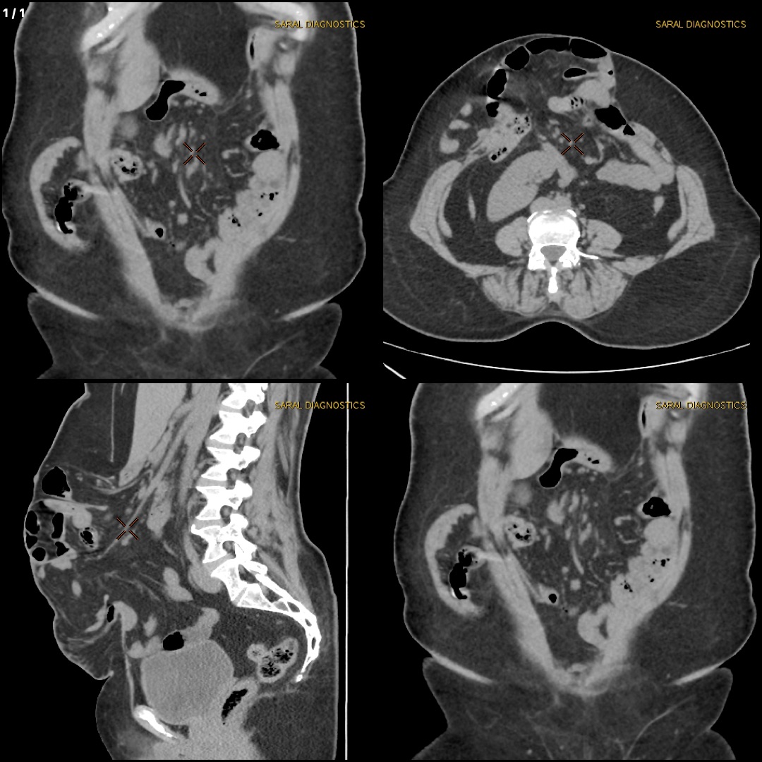 Abdomen Whole with hernia protocol (Contrast)