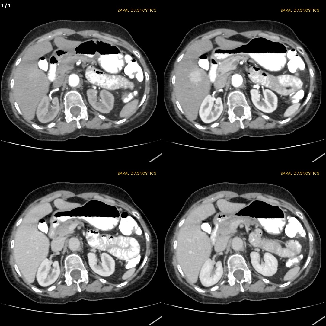 Abdomen Upper With Biphasic / Triphasic / Quadraphasic scan of Liver (Scan Charges Only)