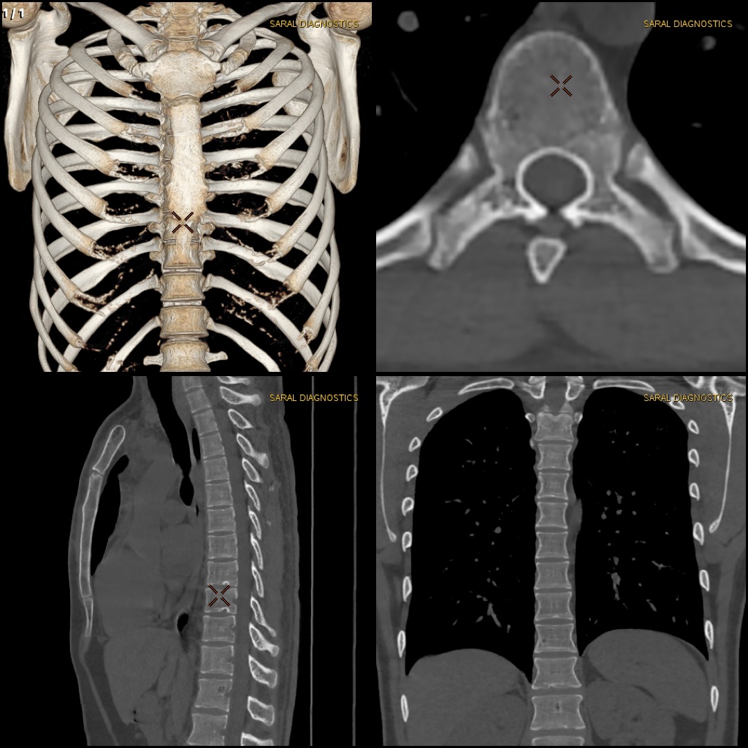 NCCT of Dorsal Spine