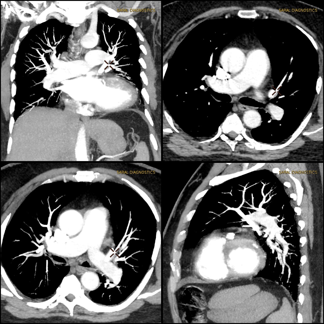 Pulmonary Angiography (Scan Charges Only)