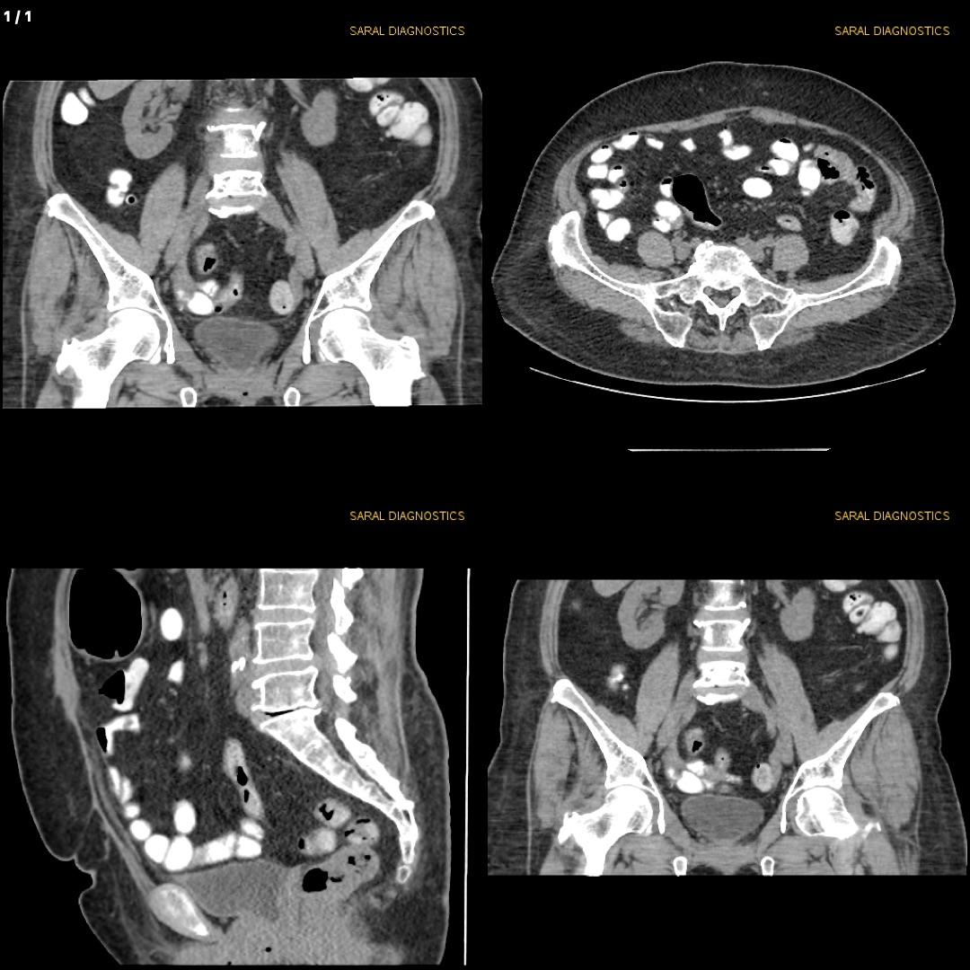 Abdomen Lower/ Pelvis Plain