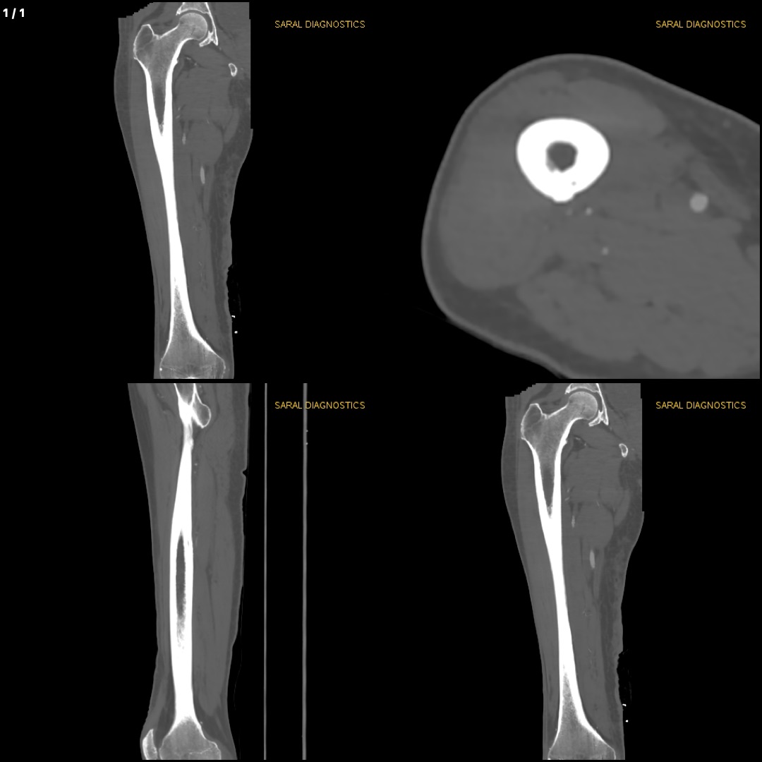 Right Thigh (Scan charges only)