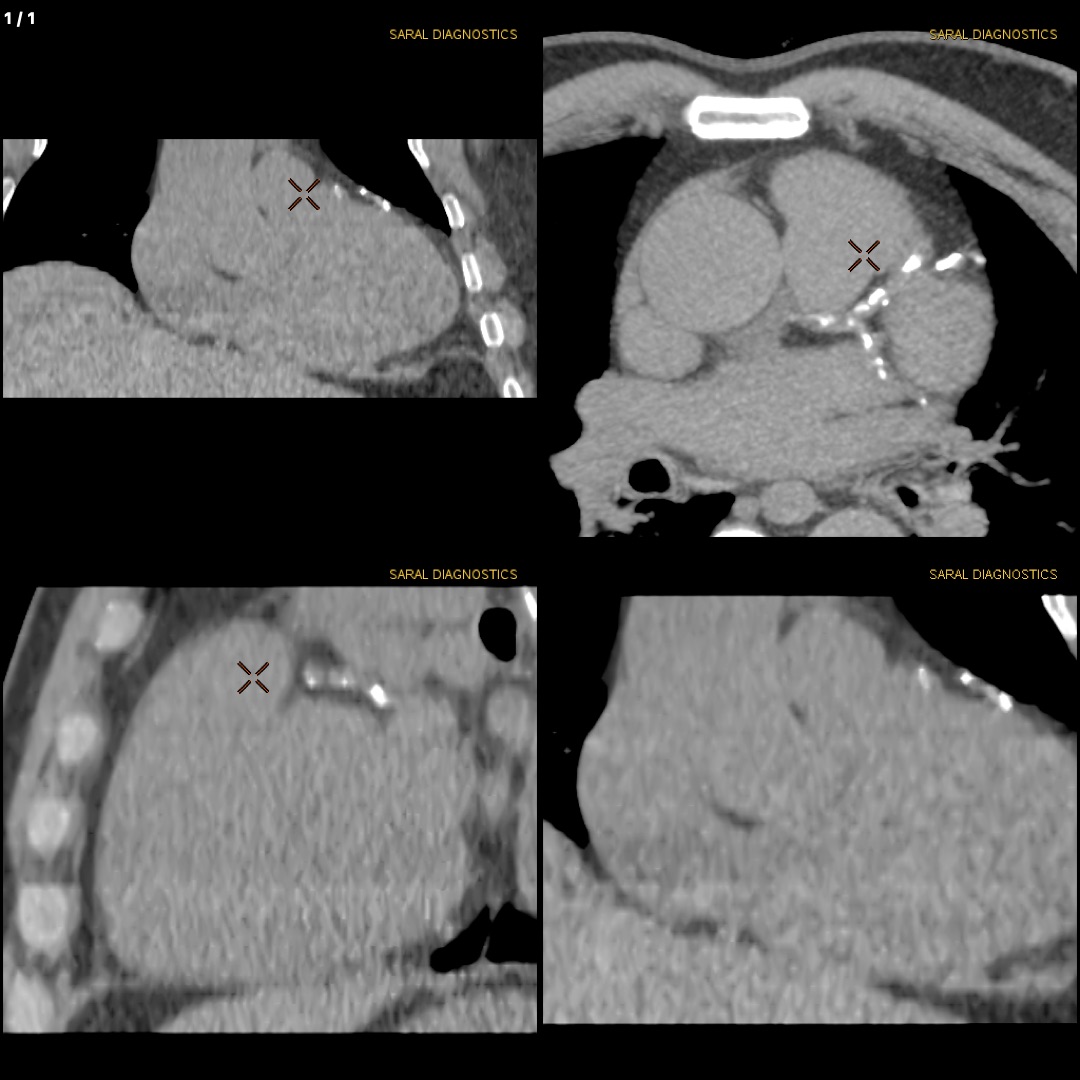 Coronary Arteries calcium scoring