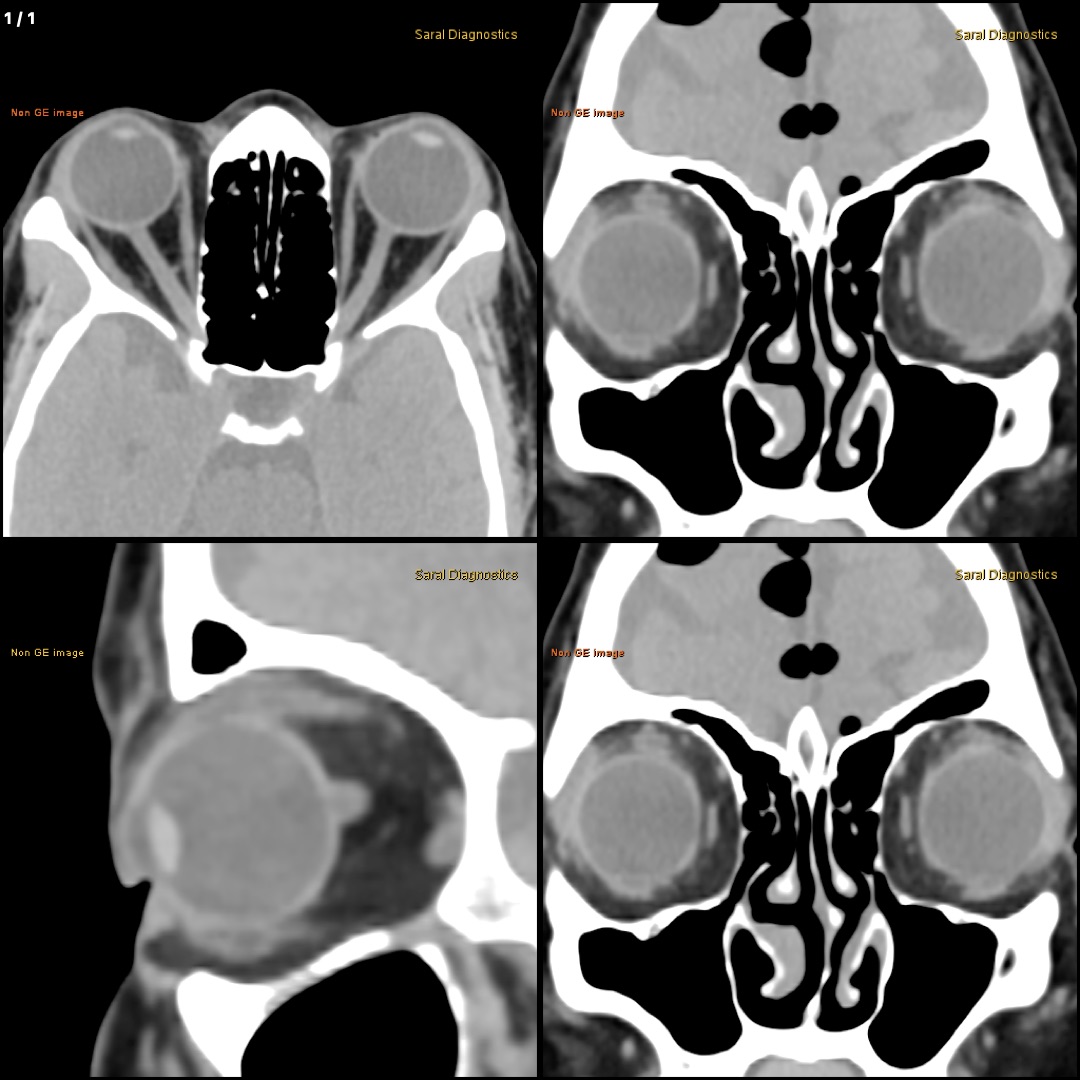 Orbit  Axial , Coronal & Saggital (Scan charges only)