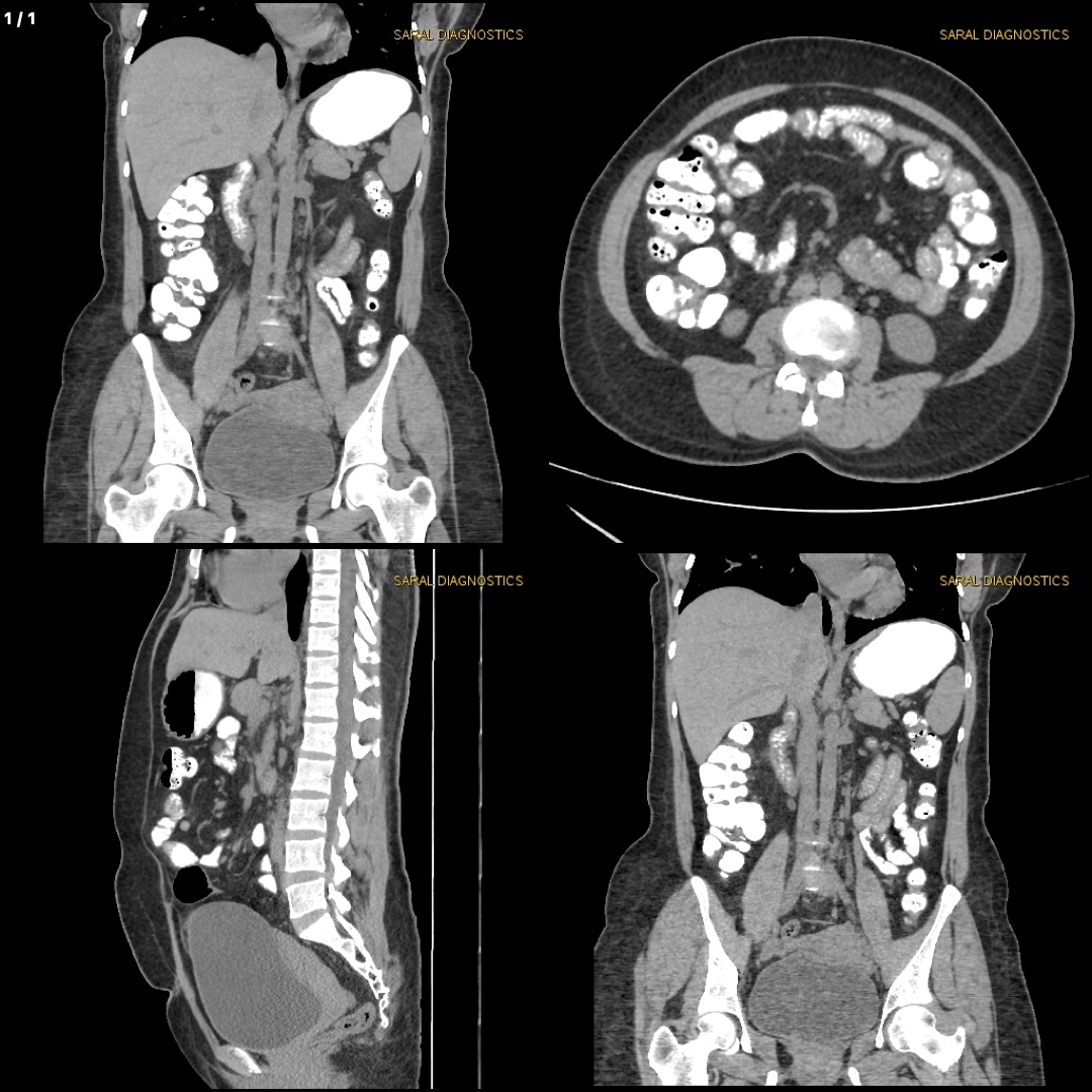 Abdomen Whole With Oral Contrast