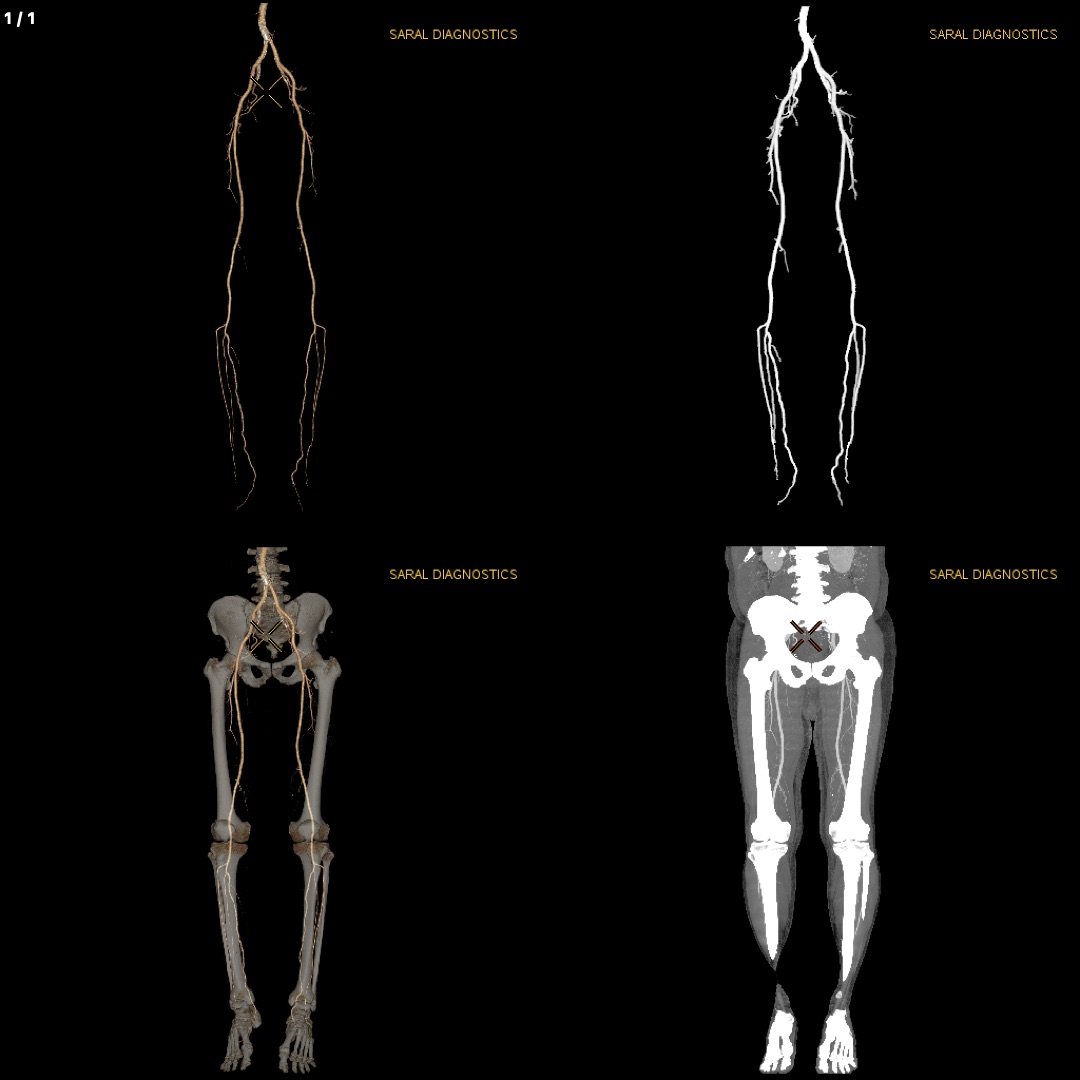 Angiography Peripheral - Upper / Lower limbs Contrast