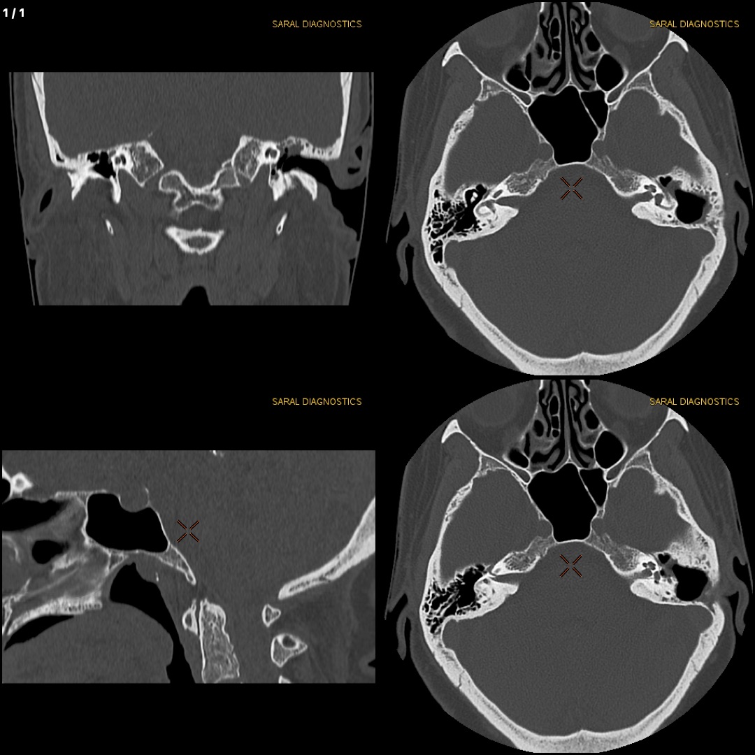 Pelvis (Bony) With Both Hip Joint (Scan Charges Only)
