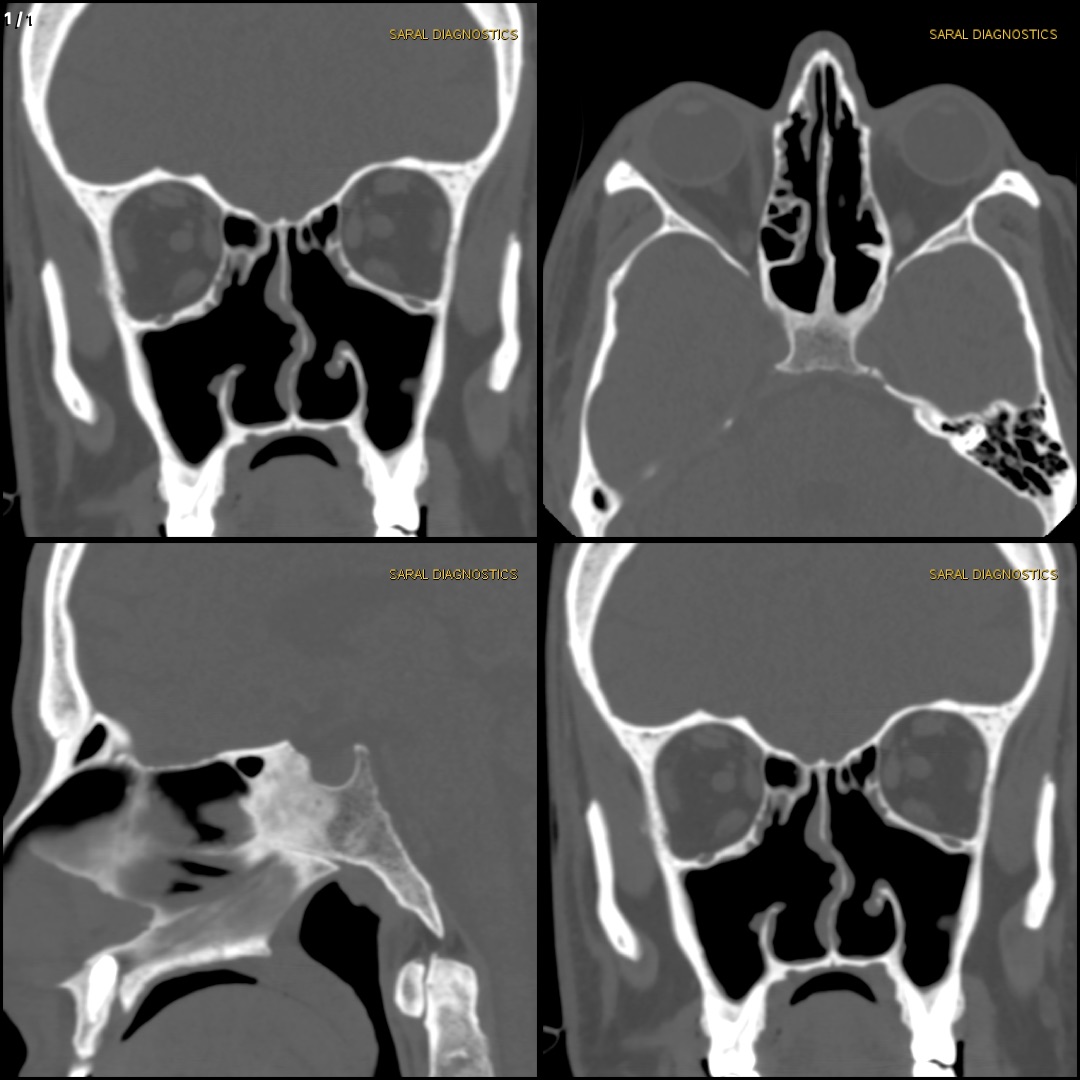 PNS (paranasal sinuses) (Scan charges only)