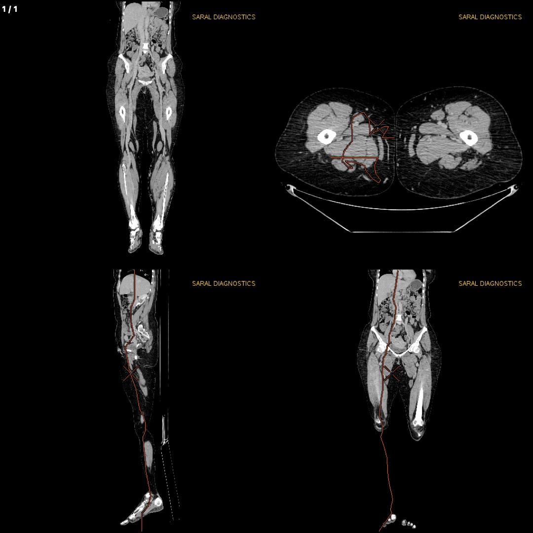 Venography abdomen with bilateral lower limb (scan charges only)