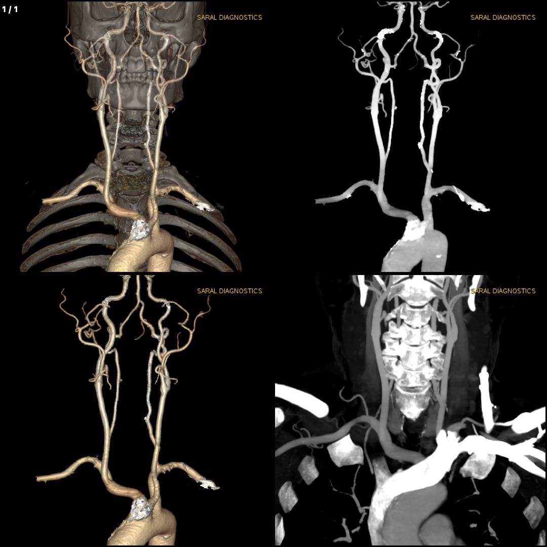 NCCT Neck with Carotid Angio (Scan Charges only)