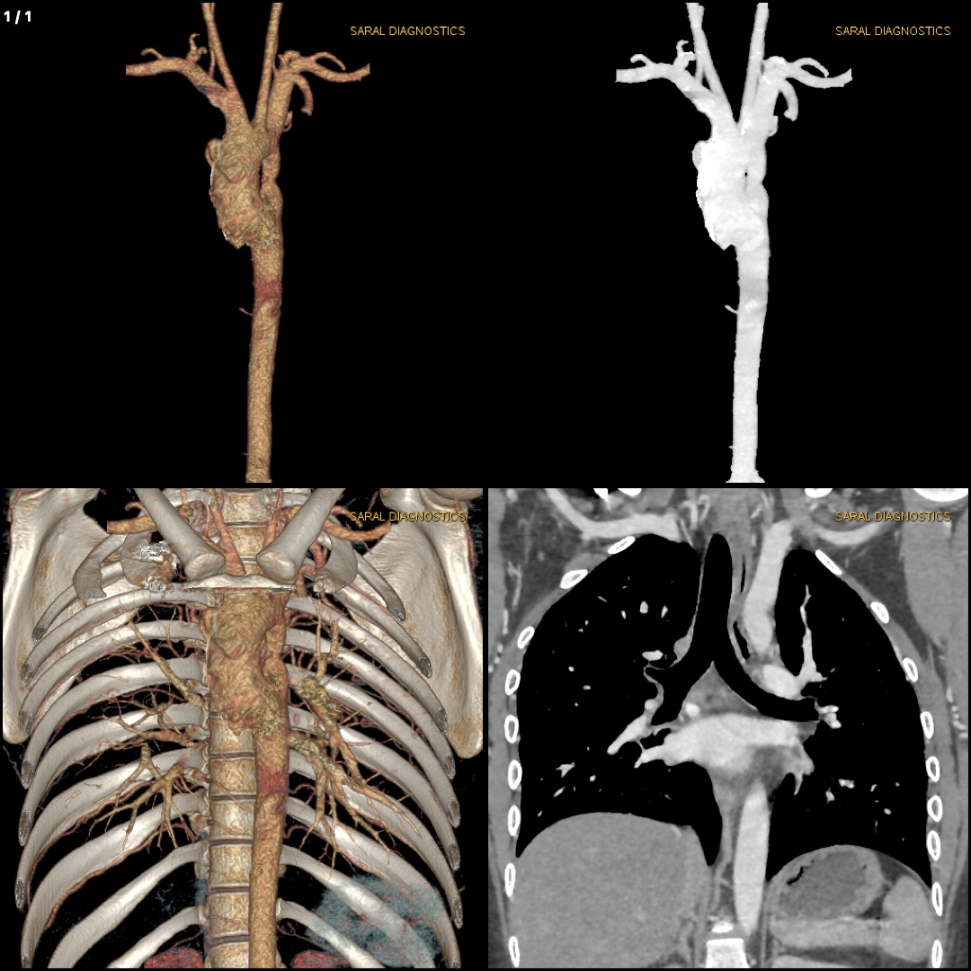 Chest with thoracic angiography(Scan Charges Only)