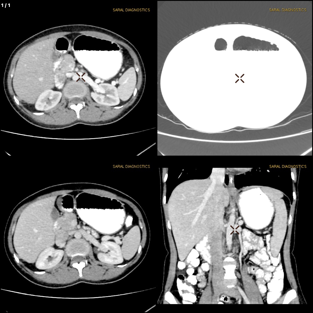Chest & Upper Abdomen (Scan Charges Only)