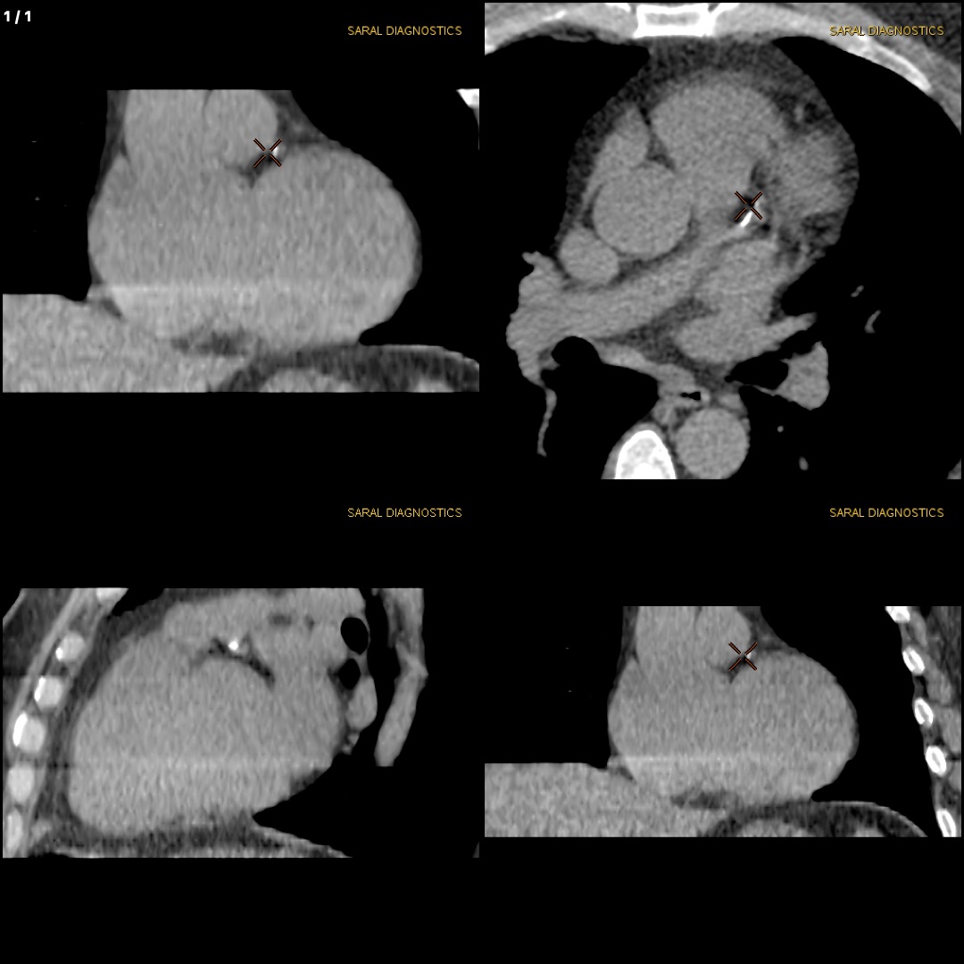 Angiography Coronary - Scan charges only