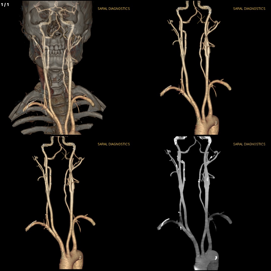 Angiography Neck & Chest (Scan Charges Only)