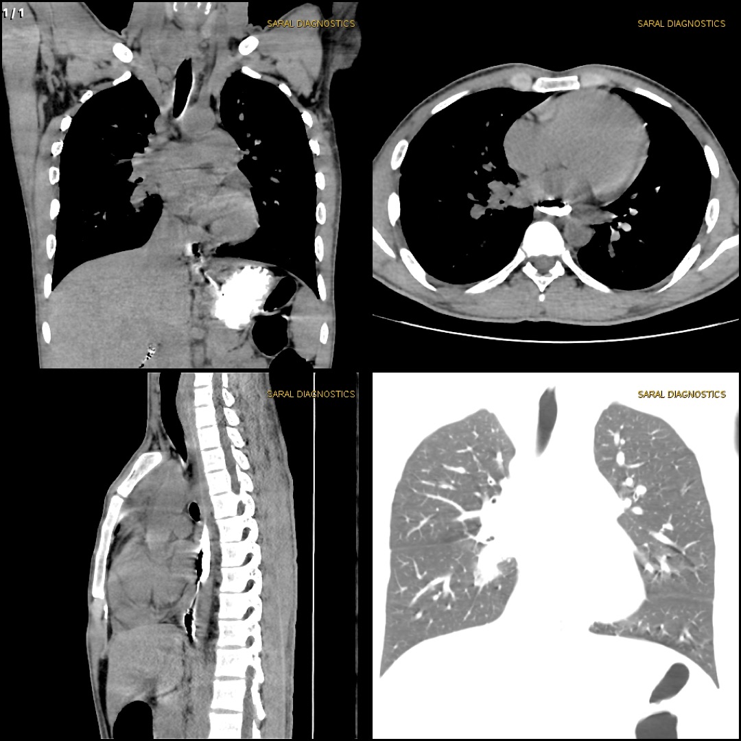 Chest / Thorax  Plain
