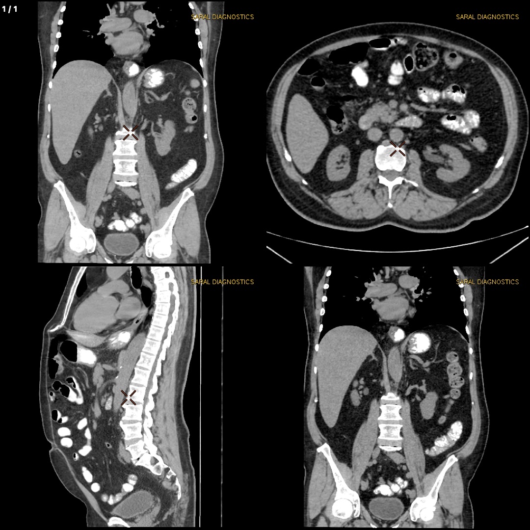 Abdomen Whole With Lower Chest  (Scan charges only)