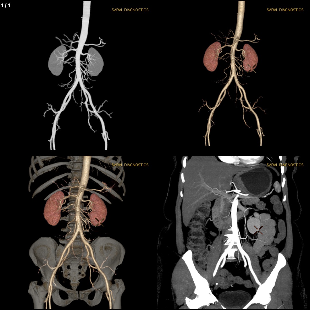 Angiography Abdomen (Scan Charges Only).