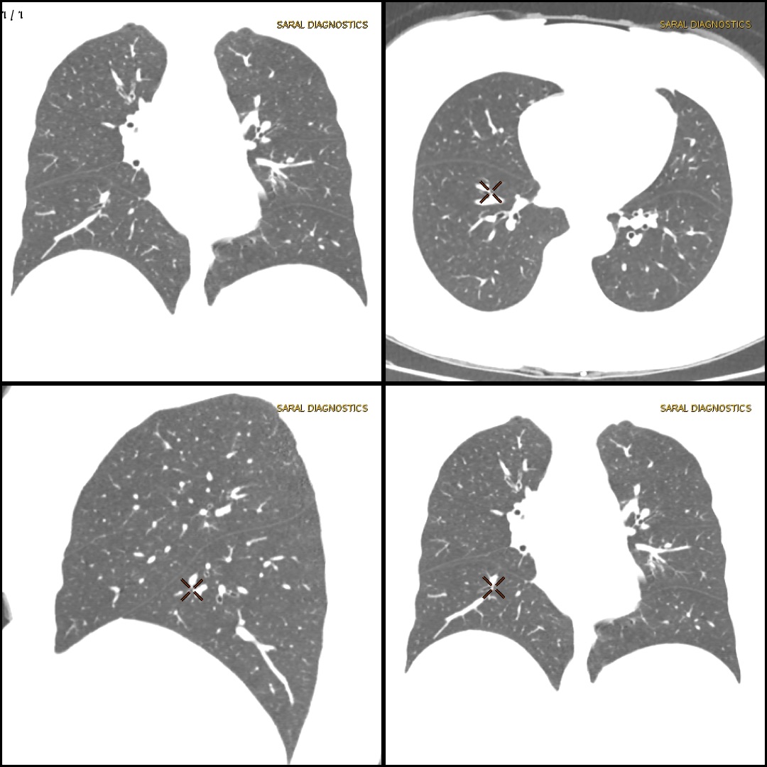 Low dose CT chest (Scan charges only)