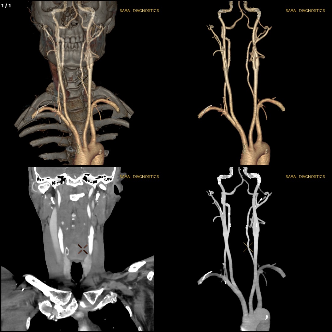 Angiography Neck / Carotid (Scan charges only)