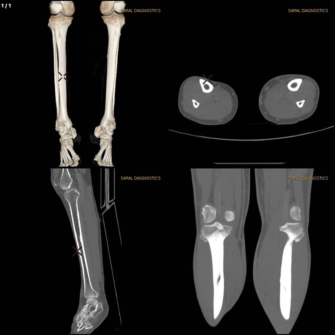 Upper / Lower Limb (Scan charges only)