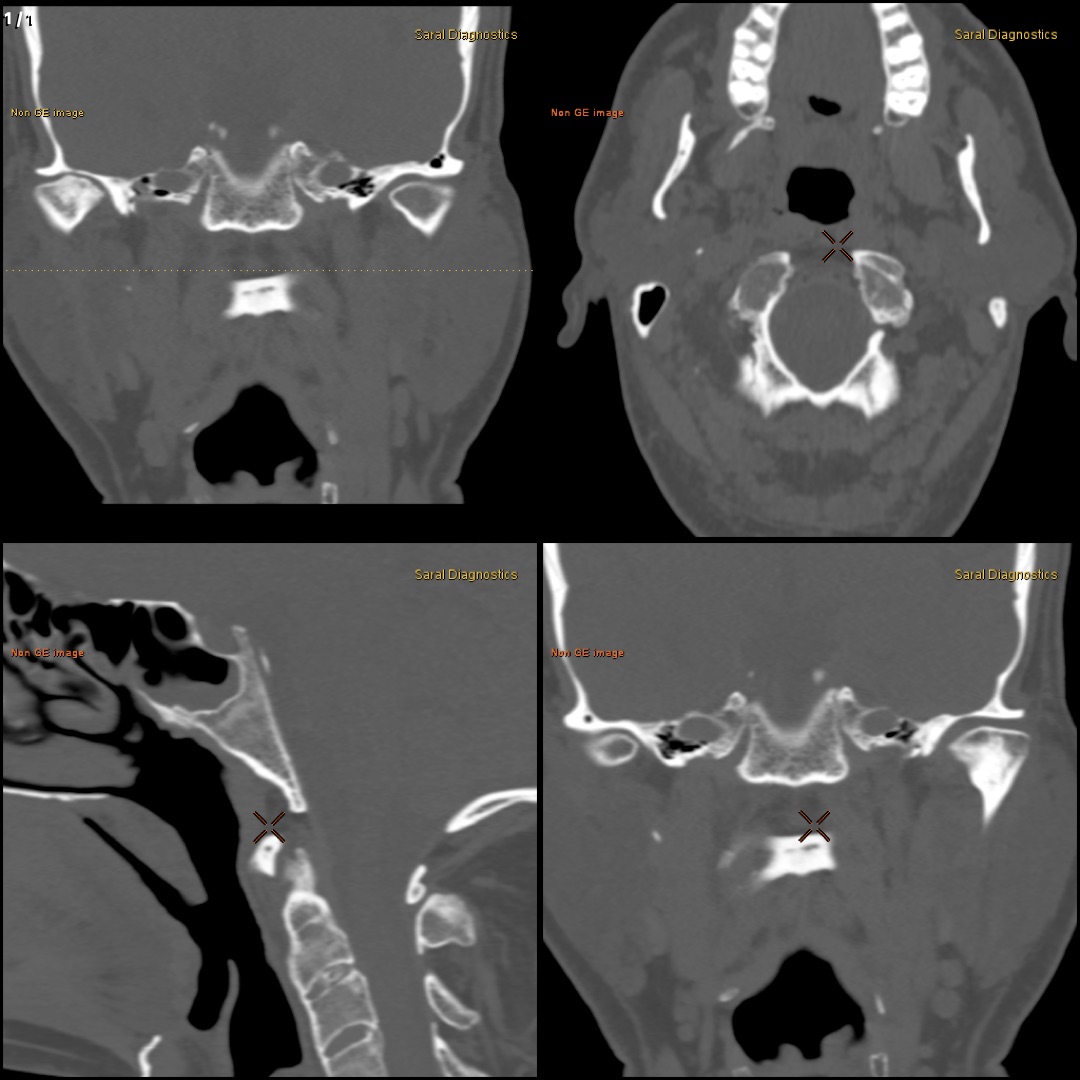 TM Joints Both Sides (Scan charges only)