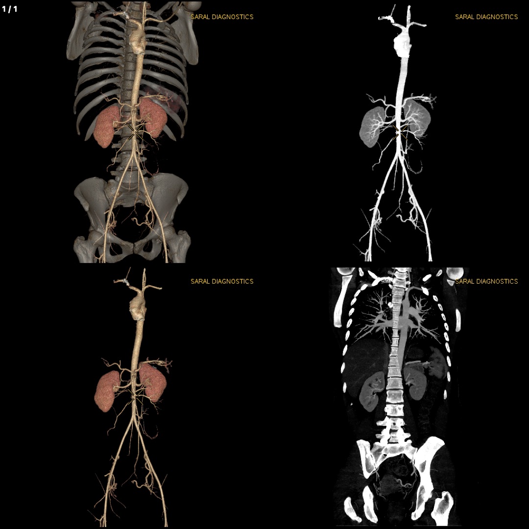 Angiography Chest & Whole Abdomen (Scan Charges Only)