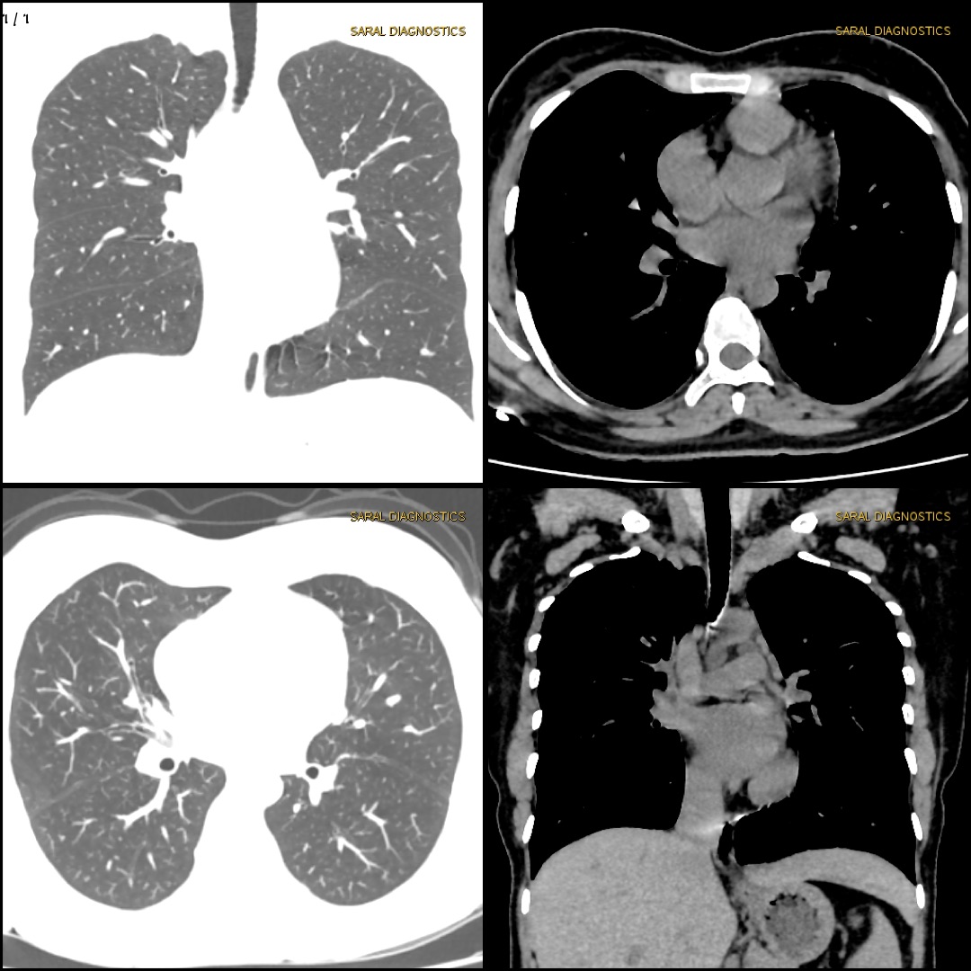 HRCT Chest (Thorax) - Plain