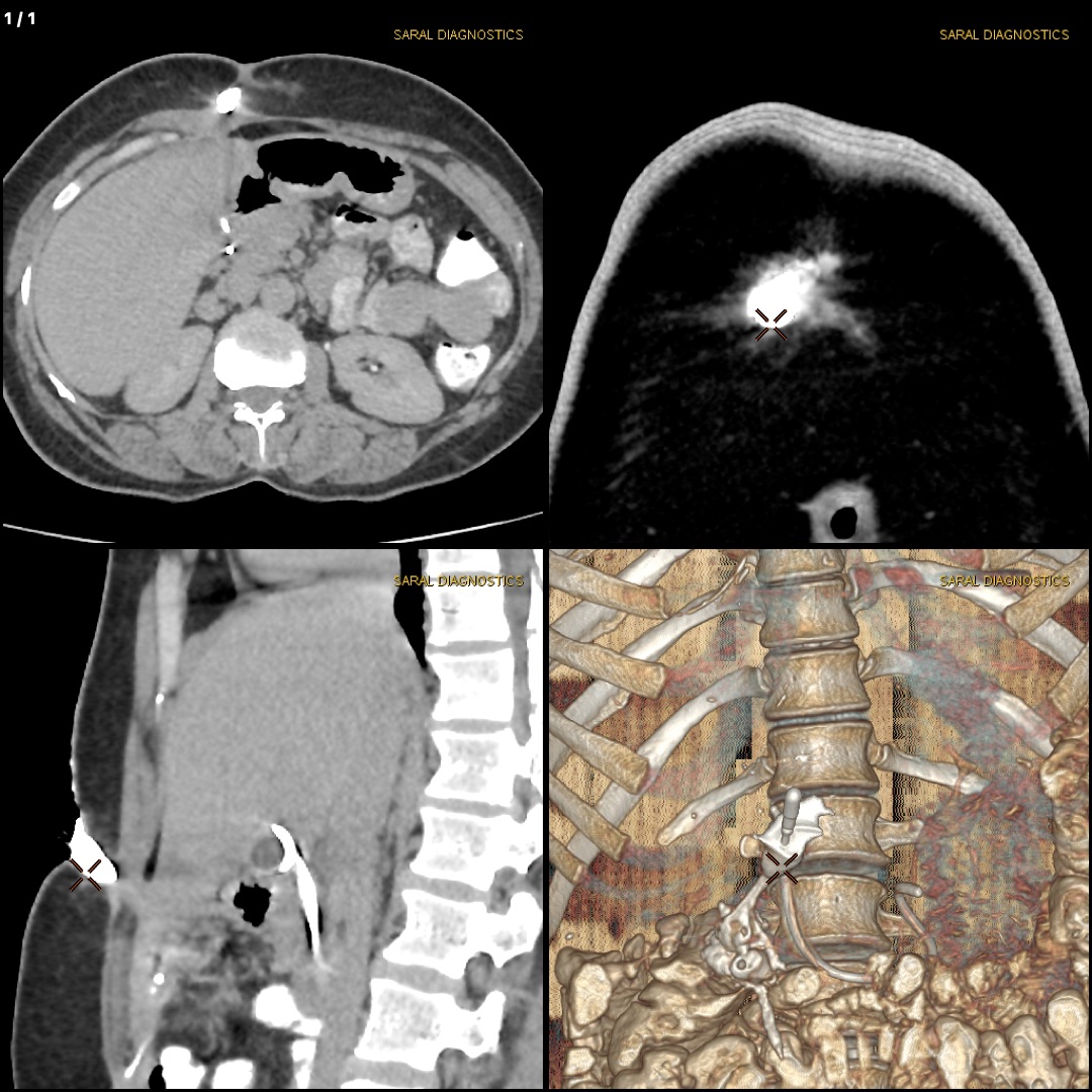 Sinogram / Fistulogram / Nephrostogram bilateral  With Contrast