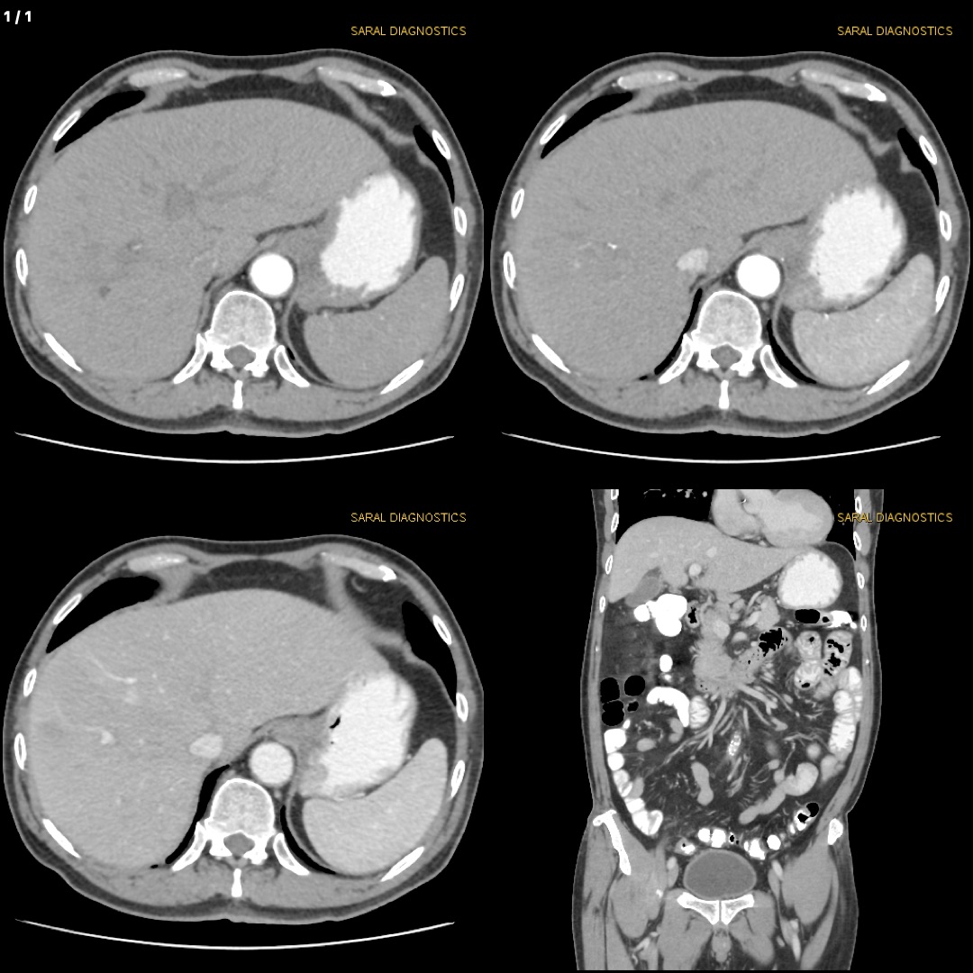 Abdomen Whole With Biphasic / Triphasic Study Contrast
