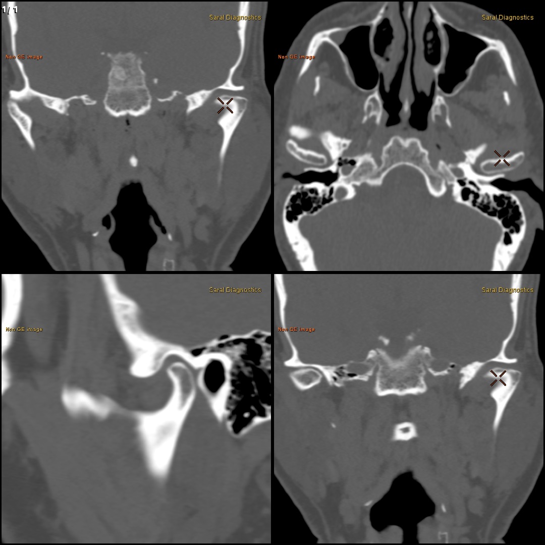 TM Joint open & close mouth (Both sides) (Contrast)