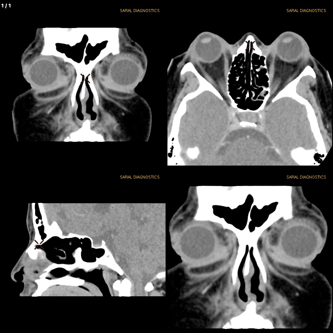 Orbit  Axial & Coronal Both (Scan charges only)