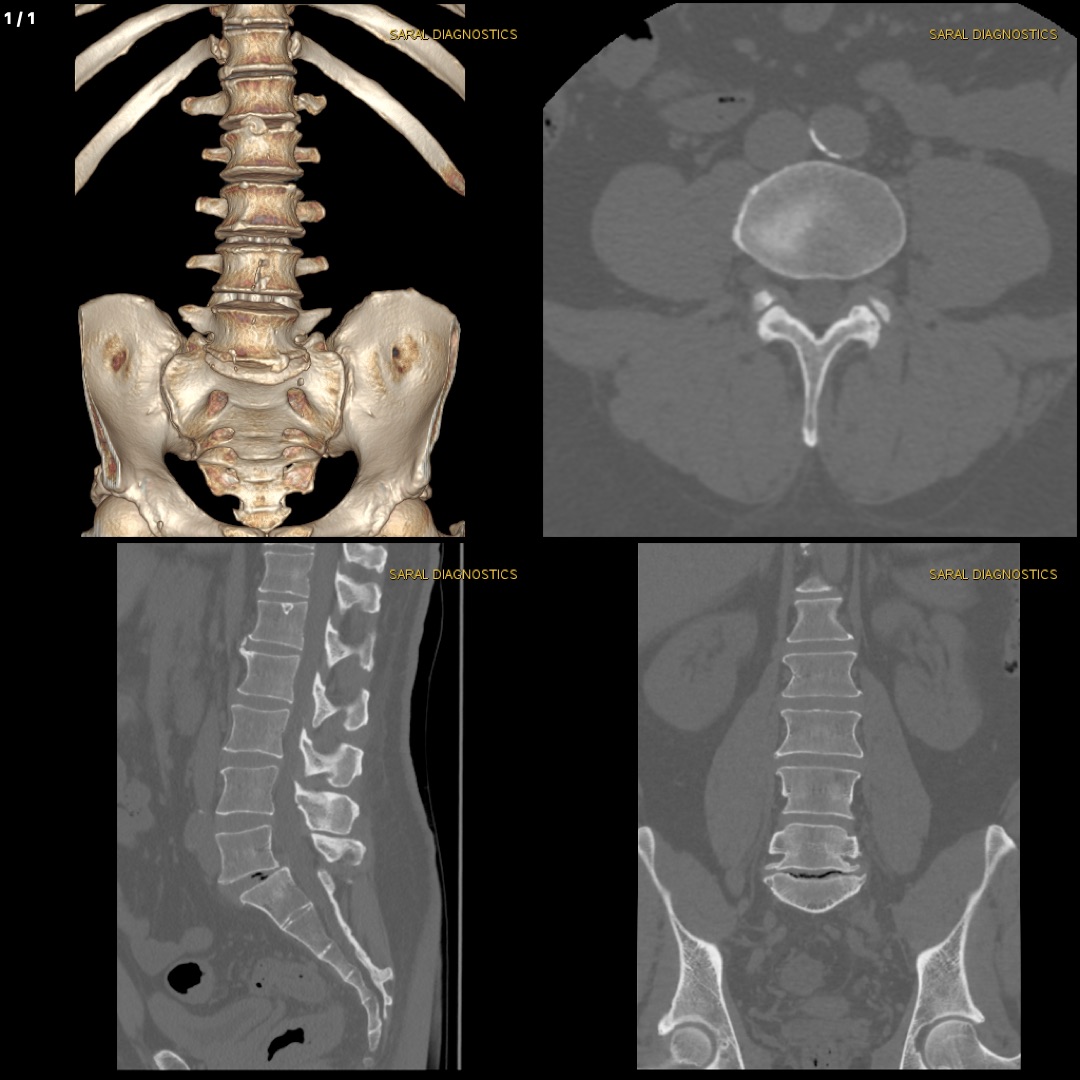 LS Spine (Scan charges only)