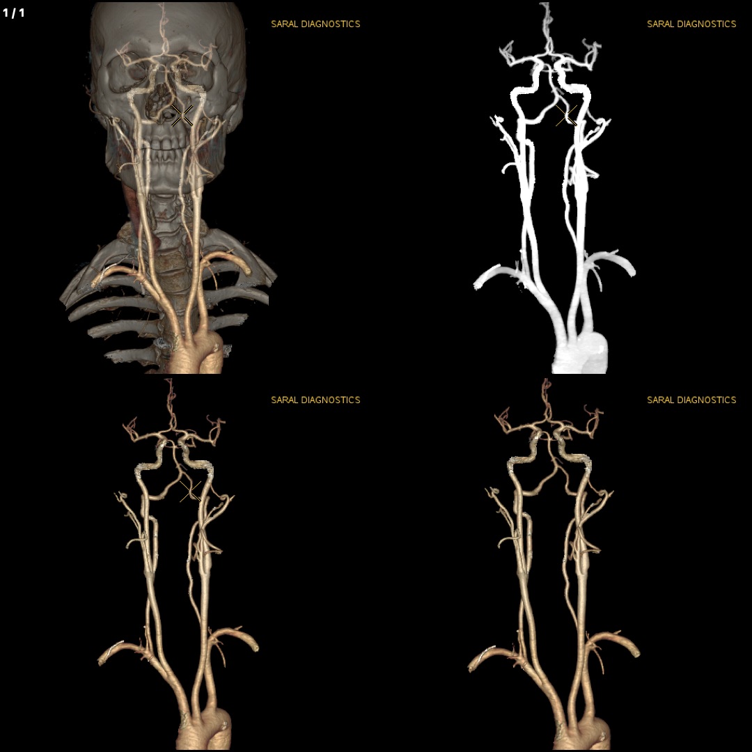 Angiography Head & Neck (Scan Charges Only)