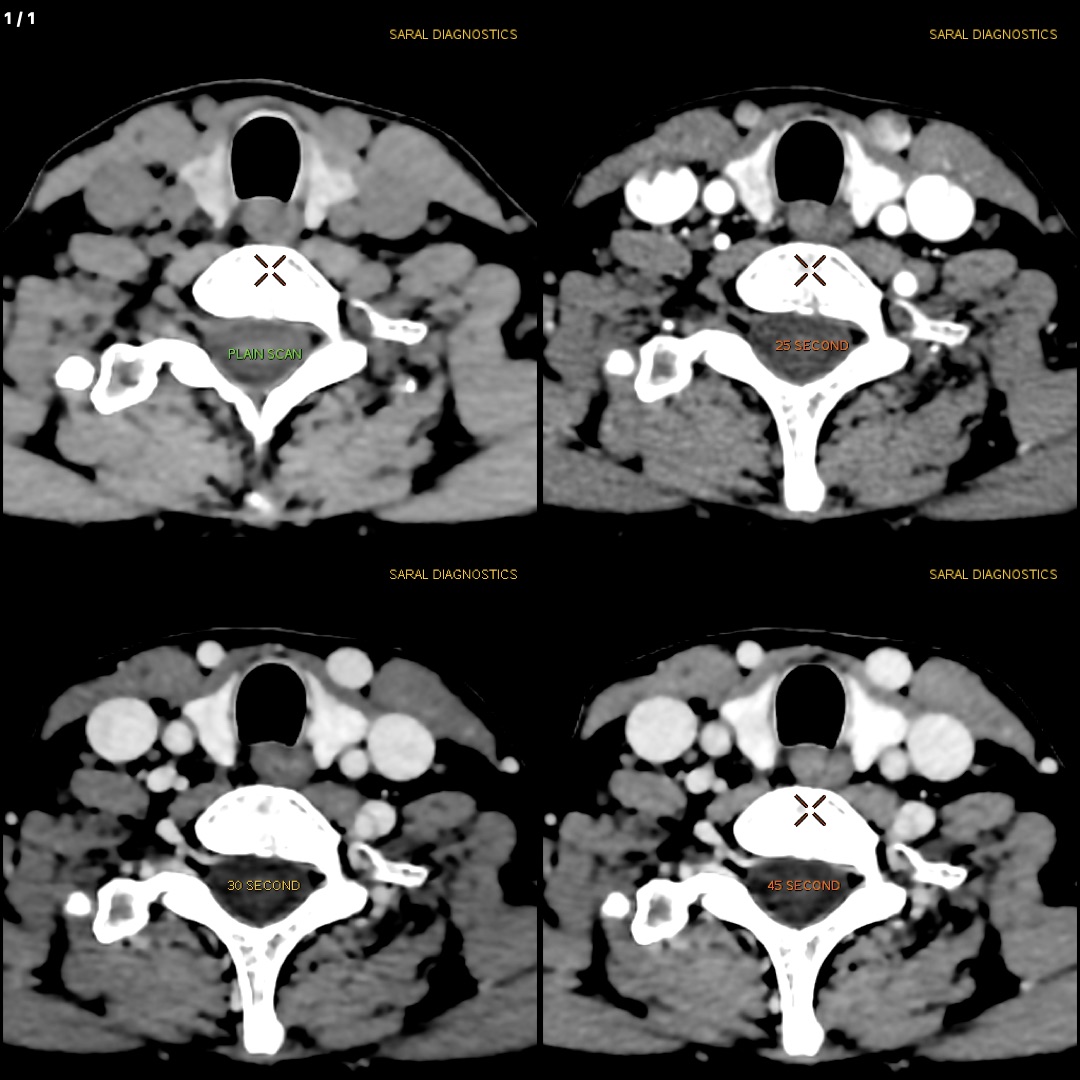 4D Parathyroid (scan charges only)