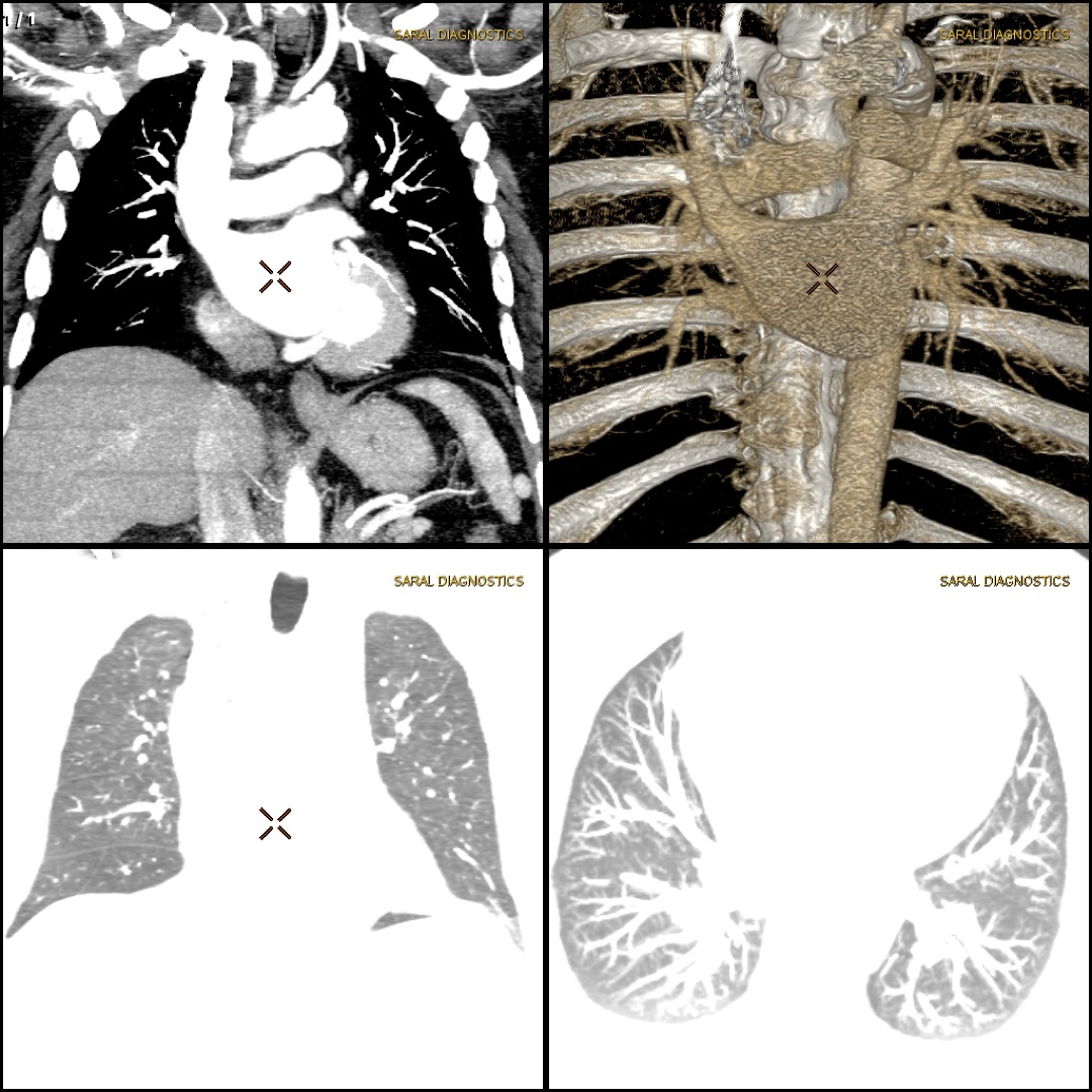 Angiography Pulmonary with CT Chest (Scan Charges Only)