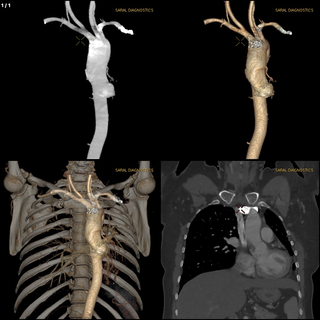 Angio Chest (thoracic) (Scan charges only)