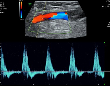 Doppler All Four Limbs Arterial