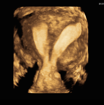 3D Gynae (Pelvis TVS)