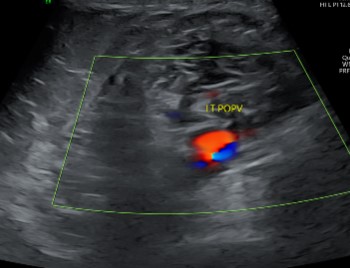 Doppler Both Limb Venous